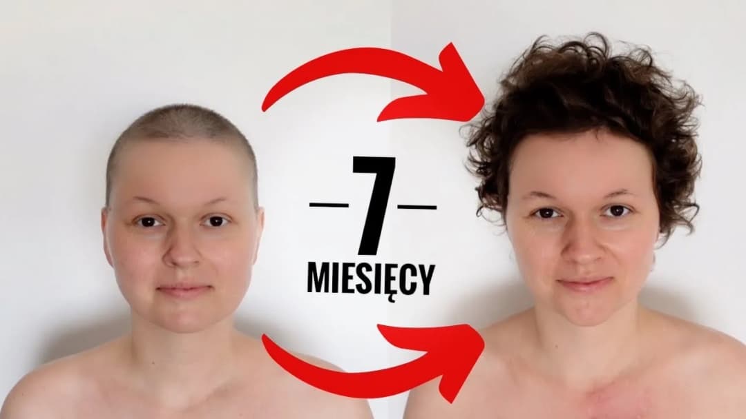 Jak szybko odrastają włosy po chemii? Poznaj kluczowe czynniki