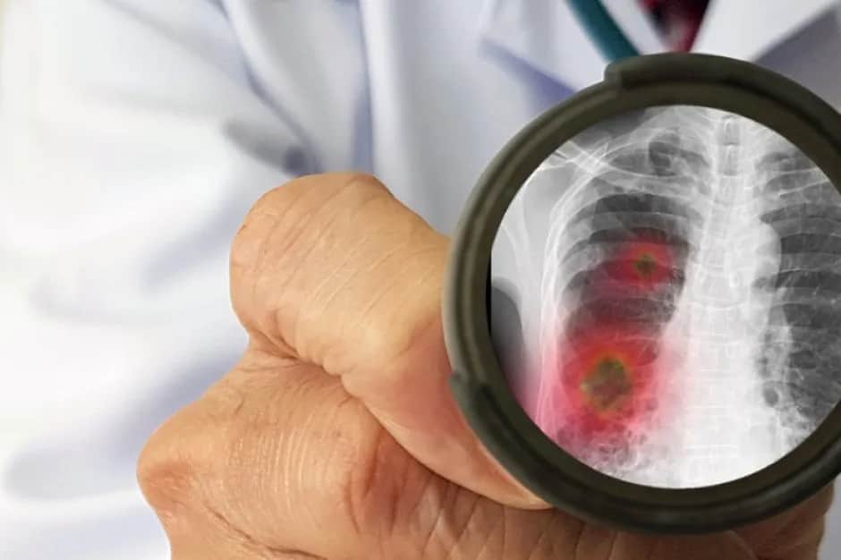 Jakie leki chemioterapeutyczne są najskuteczniejsze w raku płuc?